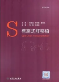 劈离式肝移植