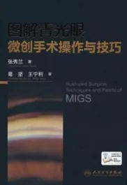 图解青光眼微创手术操作与技巧