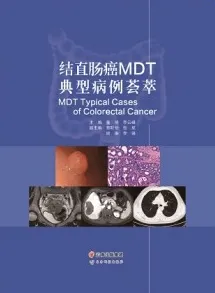 结直肠癌MDT典型病例荟萃