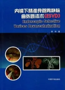 内镜下精准食管胃静脉曲张断流术