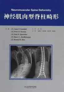 神经肌肉型脊柱畸形
