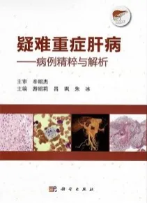 疑难重症肝病