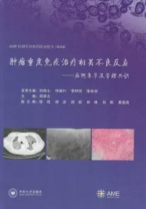 肿瘤重度免疫治疗相关不良反应 病例集萃及管理共识