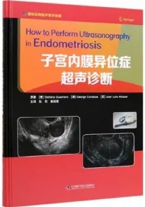 子宫内膜异位症超声诊断
