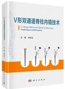 V形双通道脊柱内镜技术