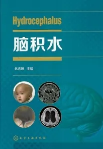 脑积水（2020）