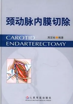 颈动脉内膜切除