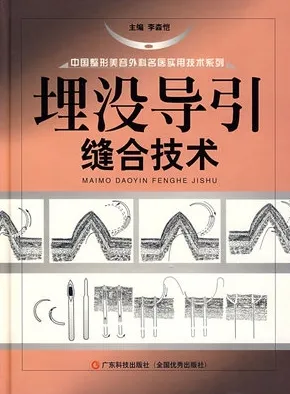 埋没导引缝合技术